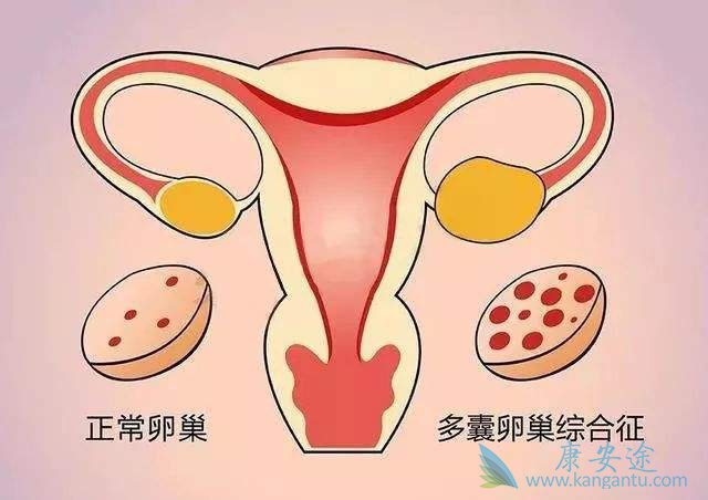 卵巢肿瘤症状是什么?卵巢癌可以活多久?