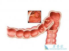 ֱ������ʲô��ֱ����֢״����Щ��