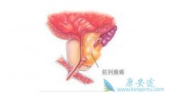 ǰ���ٰ�֢״����Щ��������ʳ����Ԥ��ǰ���ٰ��ķ�����