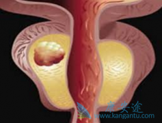 ��������(Abiraterone)�ǽ���ǰ���ٰ������������յ���Чҩ��