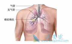 �ΰ����ڻᴫȾ��?�ΰ������ܻ�೤ʱ��