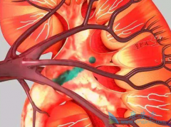 ��Щ��������(Sunitinib)������ӦԤʾ�źõ���Ч