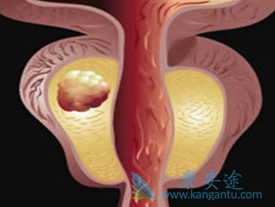 阿比特龙 阿比特龙