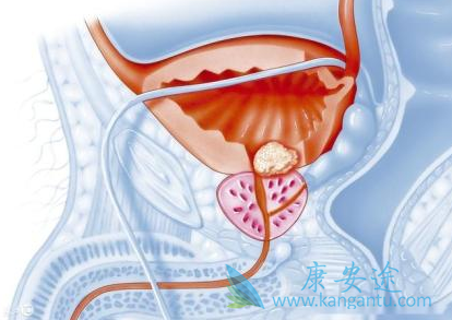 阿比特龙 阿比特龙