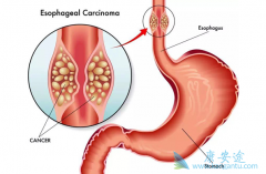 EGFR�������ߵ�ʳ�ܰ����߶Լ�������(Iressa)�ķ�Ӧ����