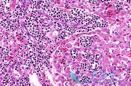 白血病传染吗 白血病传染吗