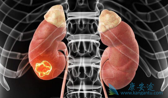 肾癌晚期 肾癌晚期