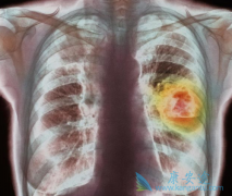 ���̵ķΰ����߿��Է��ð���ҩ�Ｊ������(GEFITINIB)��