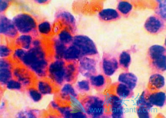 Ϊʲô���߷���ӡ�������Ȱ�(lenalidomide)�ڼ�Ҫ������ˮ