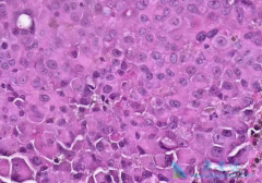 ����ҩ����������(PAZOPANIB)������Ƥ��������ֵ��