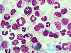 ��Ѫ��ҩ��ʩ����(Sprycel)���׸���ĩ�Ƽ����Ұ��ἤø���Ƽ�