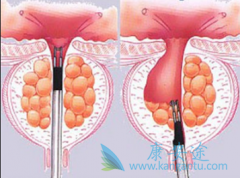 Ϊʲô��������(ABIRATERONE)��ҩ��������ǰ���ٰ�����