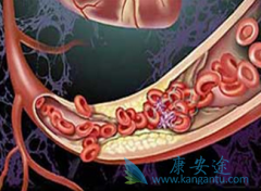 ����̹(TRACLEER)�ڲ�ͬ���ͷζ�����ѹ�����е�����Ч��