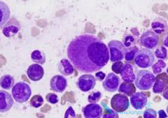 ��������(Imatinib)�����ڼ�������ֻή��ѪҩŨ��