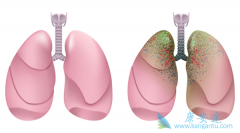 ��������(alectinib)/��ʥɯ�÷ΰ�ֻ�����Բ���Ϊ�˿���