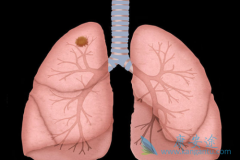 ��������(alecensa)����ALK���Էΰ���������Щ����