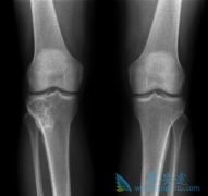 ���ټ����ĵ�ŵ����(denosumab)���������ͻ��߶��ι��۷���