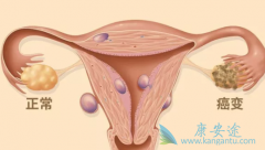 ����BRCAͻ��״̬���³������(Rubraca)��������ѳ�������PFS