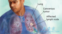 ��Ƥ�����������忪���˷�Сϸ���ΰ�NSCLC���ߵİ�������ʱ��