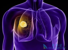 ��������(Brigatinib)����Ч��������߶�Խ������