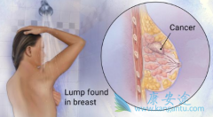 PI3K���Ƽ�Alpelisib�������ٰ����ߵ����Ƶ���Ч����