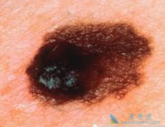 ���緢�ֺ�ɫ������֢״����ߺ�ɫ��������Ч���Ĺؼ�