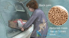 ��������֢��ҩEvenity���ձ������׼����