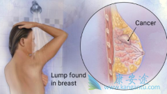 HER2�������ٰ����������ٰ����¸����Ʒ�����Щ��