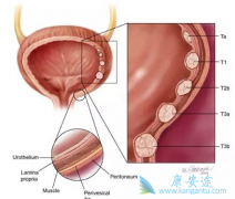 ����FGFR3ͻ����·��Ƥ������ҩvofatamab���FDA����ͨ���ʸ�