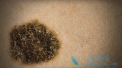 ʲô�Ǻ�ɫ���������ں�ɫ������֢״��������Щ��