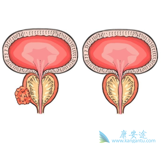 前列腺癌分期 前列腺癌分期