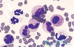 Venetoclax���������������쳣�ۺ�֢���ƴ�����ϣ��