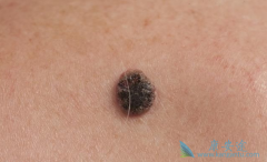 ��ɫ�������ڳ��ֳ�����֢״�������Ч���⣿