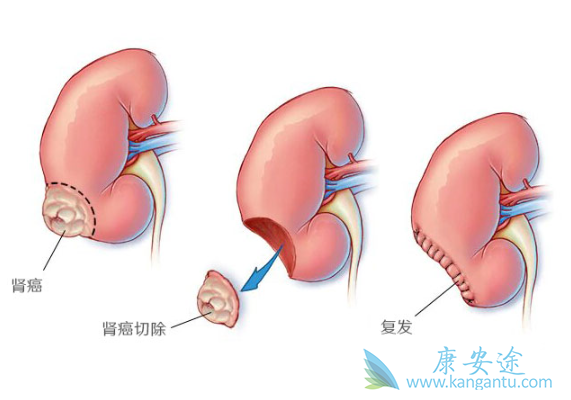 肾癌晚期 肾癌晚期