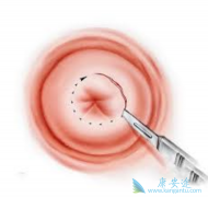 HPV��Ⱦ������Ҫ���շ���������ԭ��֮һ