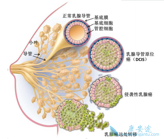 乳腺癌分期是如何划分的?不同分期有何特点?