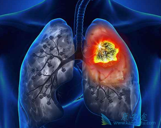 肺癌晚期怎么治疗?癌细胞会扩散吗?