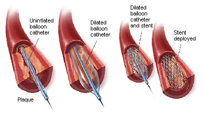 心脏支架植入术图片图片